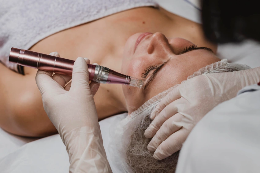 Microneedling for Acne Scars | Complete Guide & Benefits